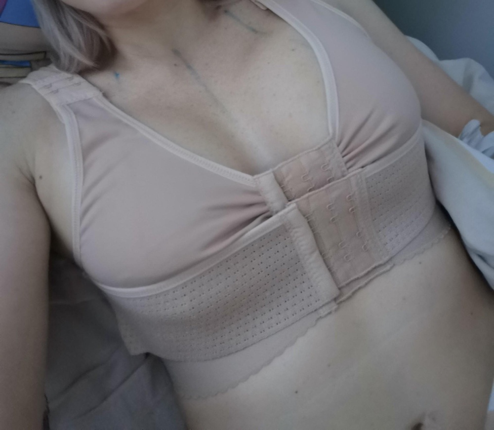Бюстгальтер отличный, компрессия хорошая. Ношу уже почти месяц после операции. Сначала ленту врач сказал носить под грудью, а потом сверху. Опг 72, ставила 380 мл. Размер 75 АБ подошёл прекрасно. Размер 70 АБ ущковат под грудью. В магазине такой от 3900 стоит. Спасибо большое!