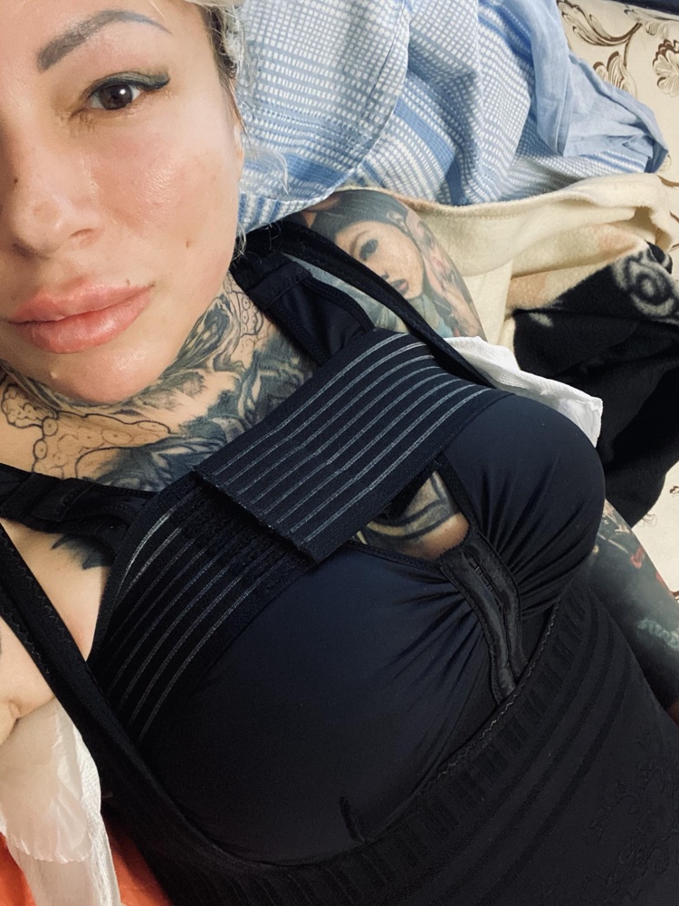 Пластический хирург сказал лучший по своей конфигурации бюст компрессионный. Что скажу я , девочки он очень удобный , размерная сетка совпадает на 100% , делала увеличение груди до 4 размера,ношу уже неделю. То что ругаются на перекладину над грудью , такая история во всех даже люксовых по цене бюстах, на личном опыте советую перед операцией сделать мягкие нашивки в местах подмышек , без них конечно тяжело но перекладина очень нужная вещь. Фото прилагаю .