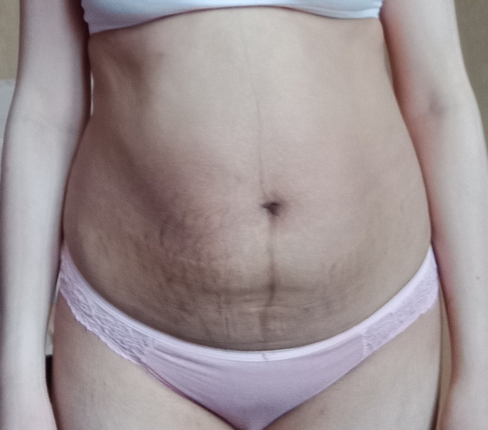 Мне очень понравилось, сперва я вытаскивала из упаковки смотрю блин мне большой 😂, патом надела оказывается я потолстела, очень классное корсет советую ❤️ первый фото это после родов 3дня 🥰